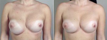 Removal & Replacement of Implants Patient 21