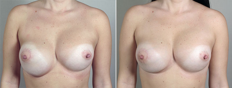 Removal & Replacement of Implants Patient 21