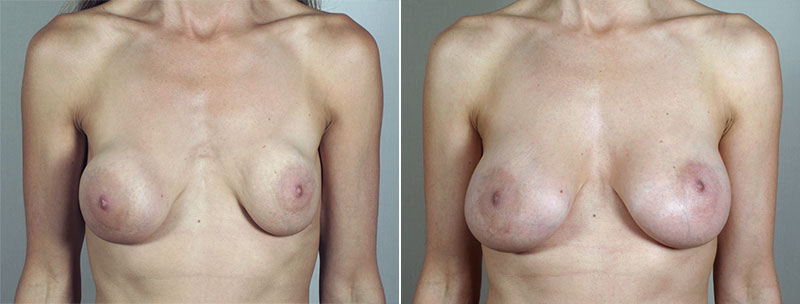 Removal & Replacement of Implants Patient 22