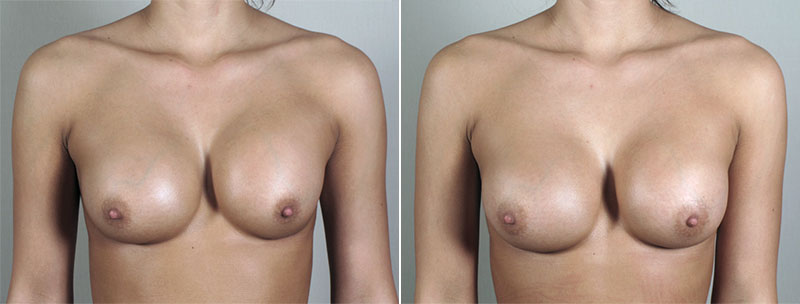 Removal & Replacement of Implants Patient 23