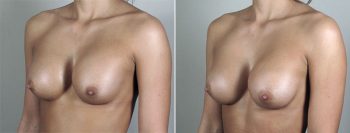 Removal & Replacement of Implants Patient 23