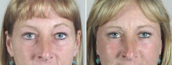 Face Lift Patient 27