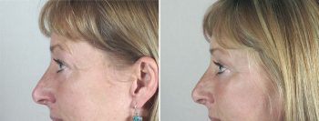 Face Lift Patient 27
