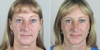 Face Lift Patient 27