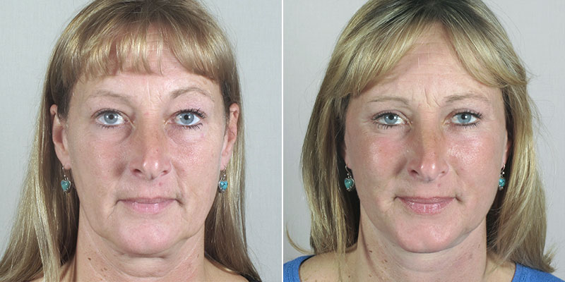 Face Lift Patient 27