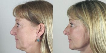 Face Lift Patient 27