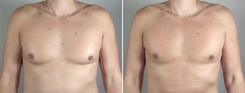 Male Liposuction Patient 22