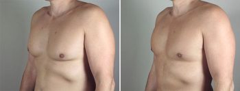 Male Liposuction Patient 22