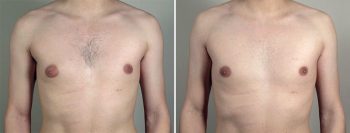 Gynecomastia Reduction Patient 39