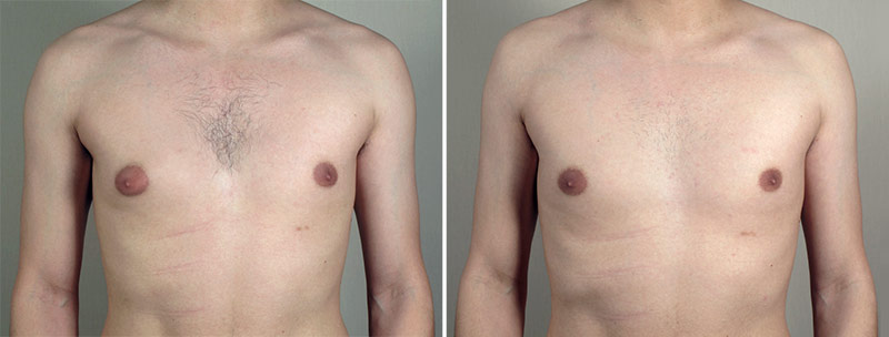 Gynecomastia Reduction Patient 39