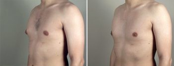 Gynecomastia Reduction Patient 39