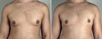 Gynecomastia Reduction Patient 40