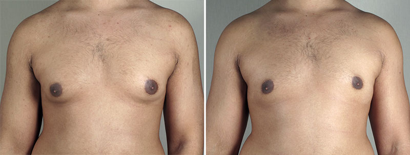 Gynecomastia Reduction Patient 40