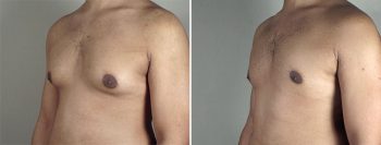 Gynecomastia Reduction Patient 40