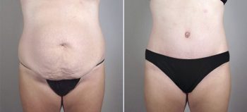 Liposuction Patient 56