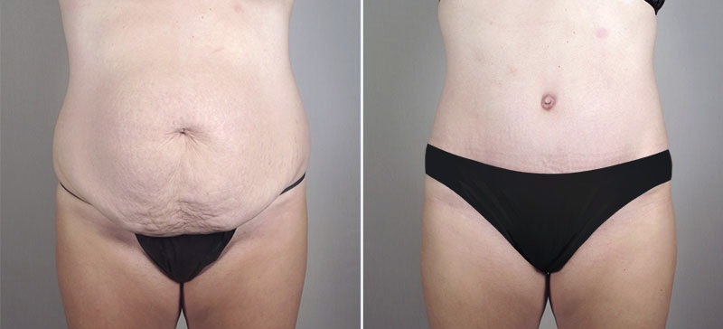 Liposuction Patient 56