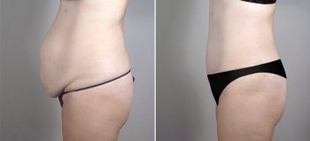 Liposuction Patient 56