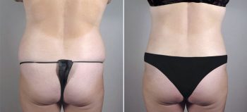 Liposuction Patient 56