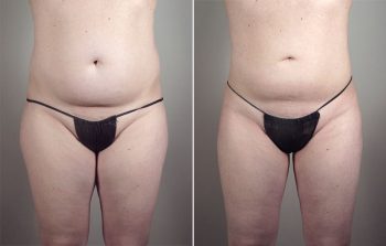 Liposuction Patient 54