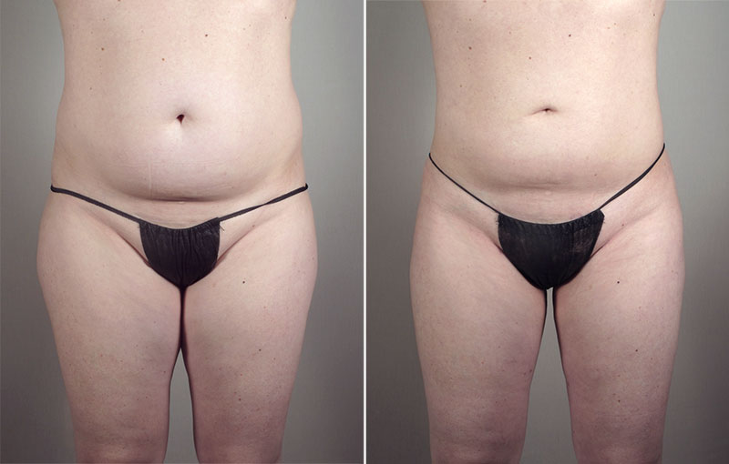 Liposuction Patient 54