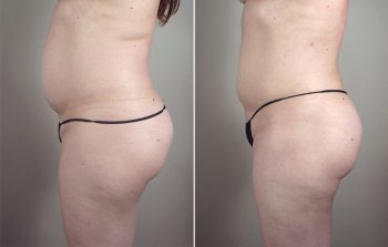 Liposuction Patient 54