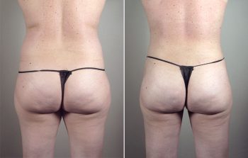 Liposuction Patient 54