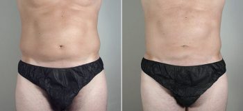 Male Liposuction Patient 22
