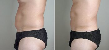Male Liposuction Patient 22