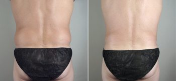 Male Liposuction Patient 22