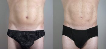 Male Liposuction Patient 23