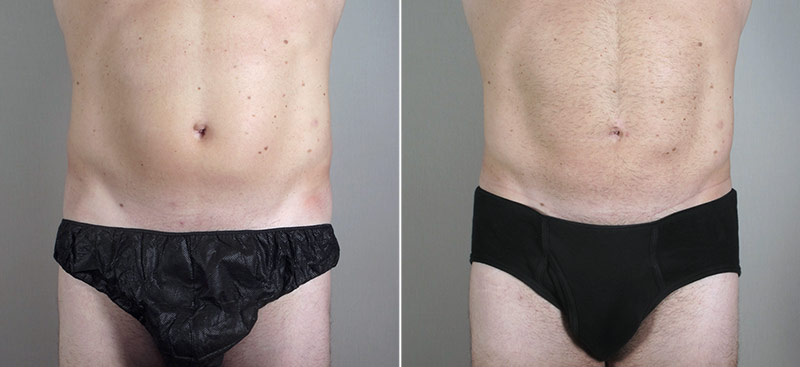Male Liposuction Patient 23