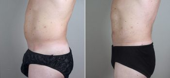Male Liposuction Patient 23