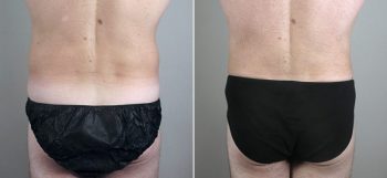Male Liposuction Patient 23