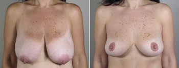 Breast Lift with Auto-Augmentation Patient 4