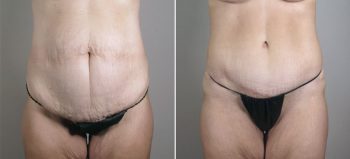 Breast Lift with Auto-Augmentation Patient 4