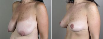 Breast Lift with Auto-Augmentation Patient 4