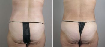 Breast Lift with Auto-Augmentation Patient 4