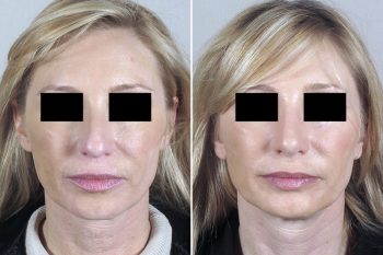 Neck Lift Patient 8
