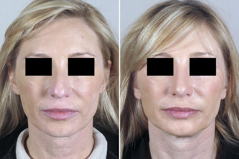 Neck Lift Patient 8