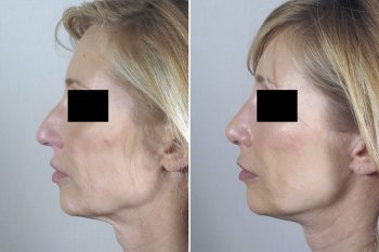 Neck Lift Patient 8