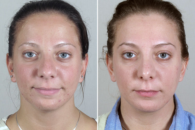 Rhinoplasty Patient 50