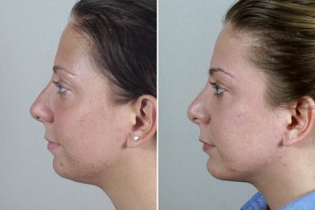 Rhinoplasty Patient 50