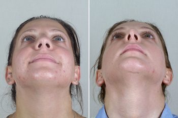 Rhinoplasty Patient 50