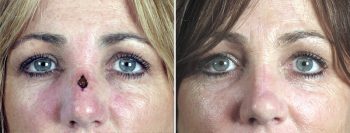 Skin Cancer Treatment Patient 40