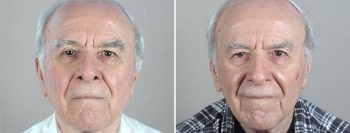 Skin Cancer Treatment Patient 41