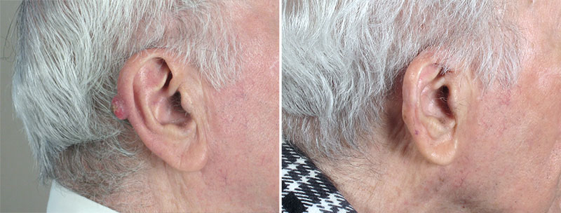 Skin Cancer Treatment Patient 41