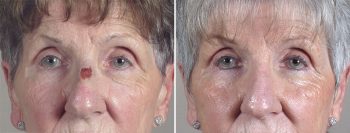 Skin Cancer Treatment Patient 42