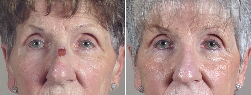 Skin Cancer Treatment Patient 42