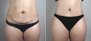 Liposuction Patient 57
