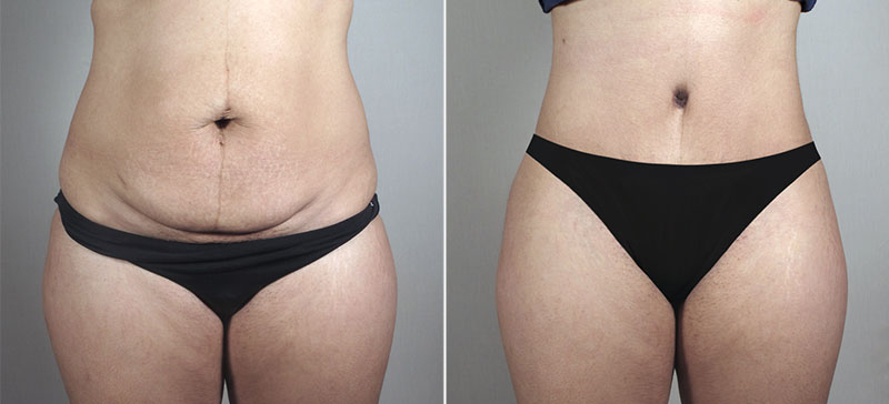 Liposuction Patient 57